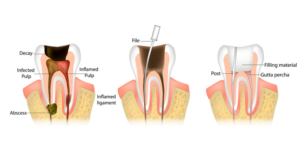 stages of root canal treatment diagram