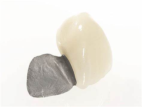 dental bridge