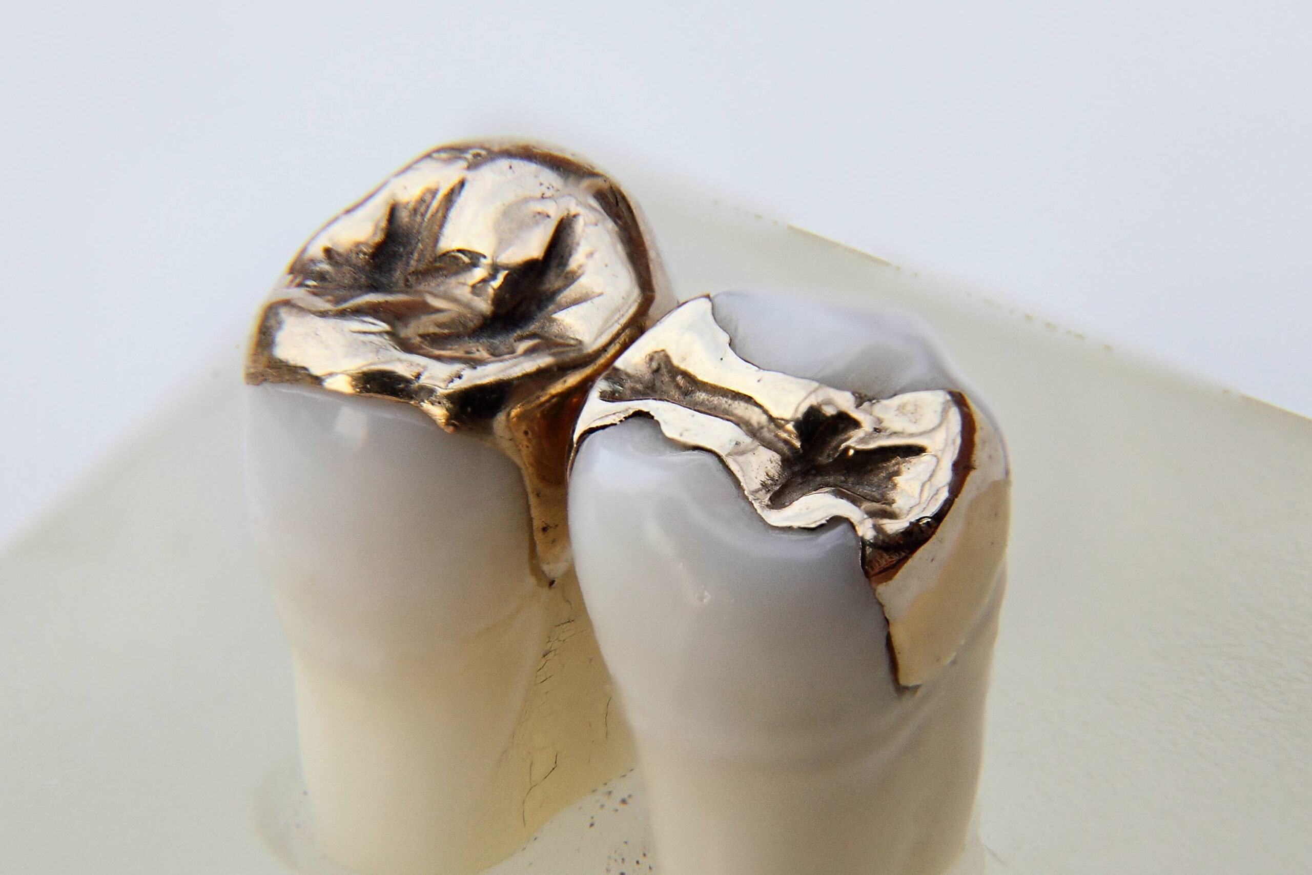 gold onlays in teeth