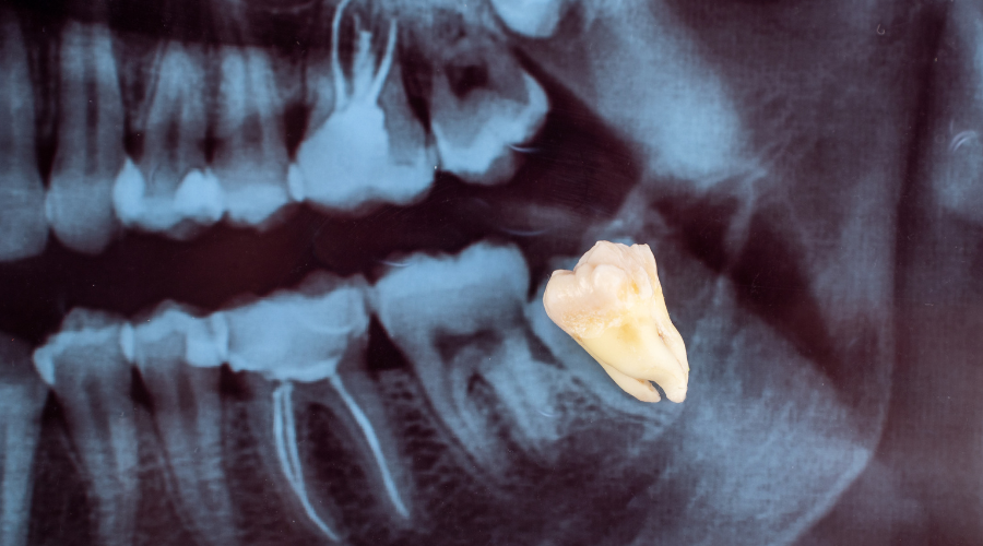 Xray Wisdom Teeth Extractions in Plymouth