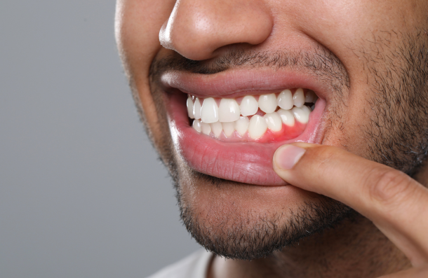 Man with red gums from Gingivitis