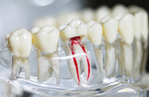 Root Canal 
