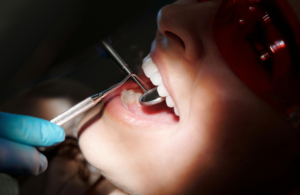 Wisdom teeth extraction Plymouth