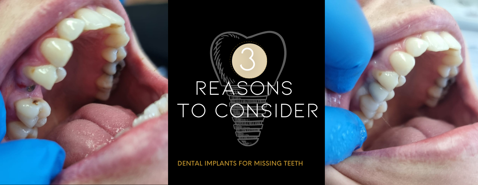 3 reasons to consider dental implants