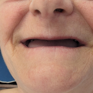 Before dental implants