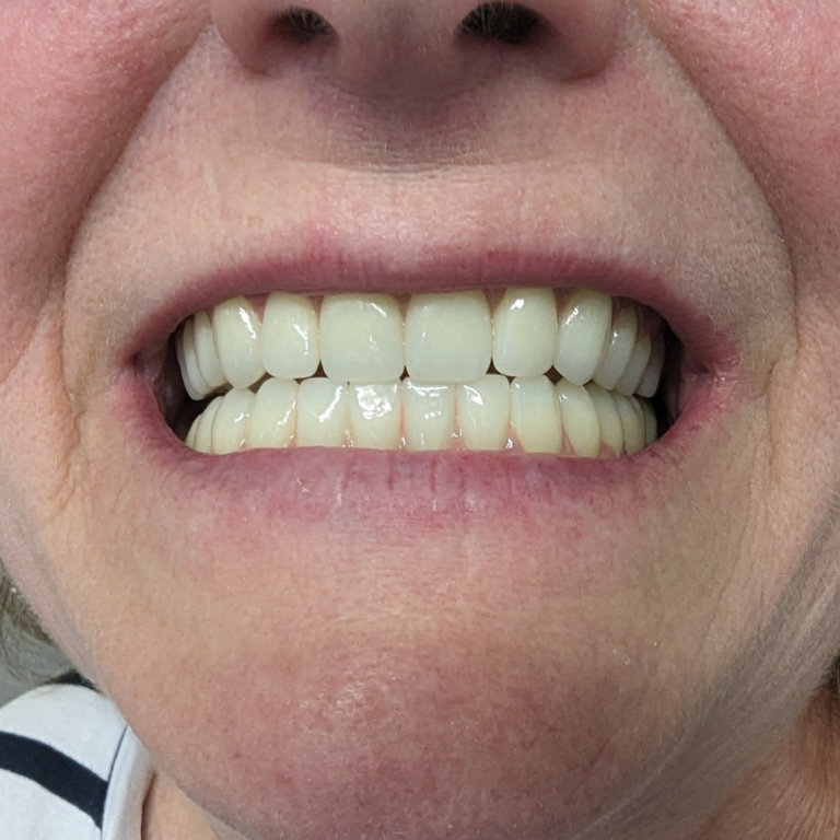 After implant retained dentures