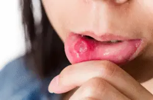 Mouth Ulcer