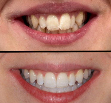 Invisalign