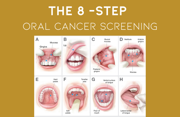 The 8 step oral cancer screening graphic