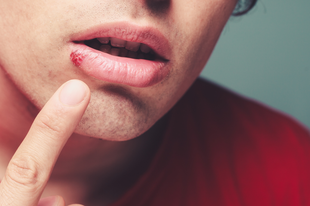 Cold sore on mouth