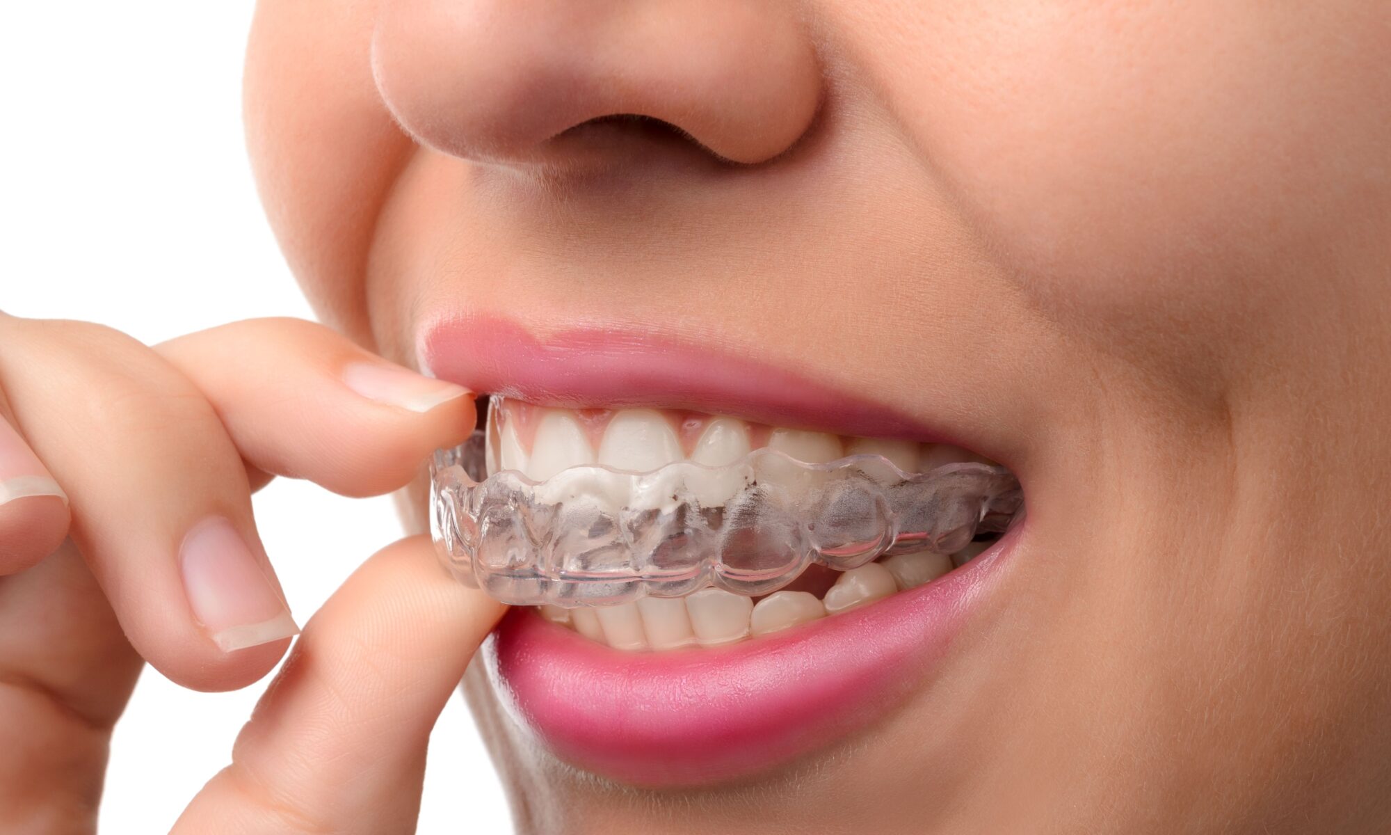 SureSmile Aligners
