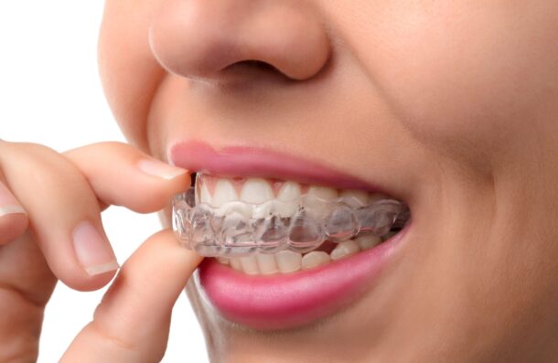 SureSmile Aligners