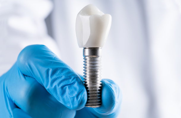 dental implant
