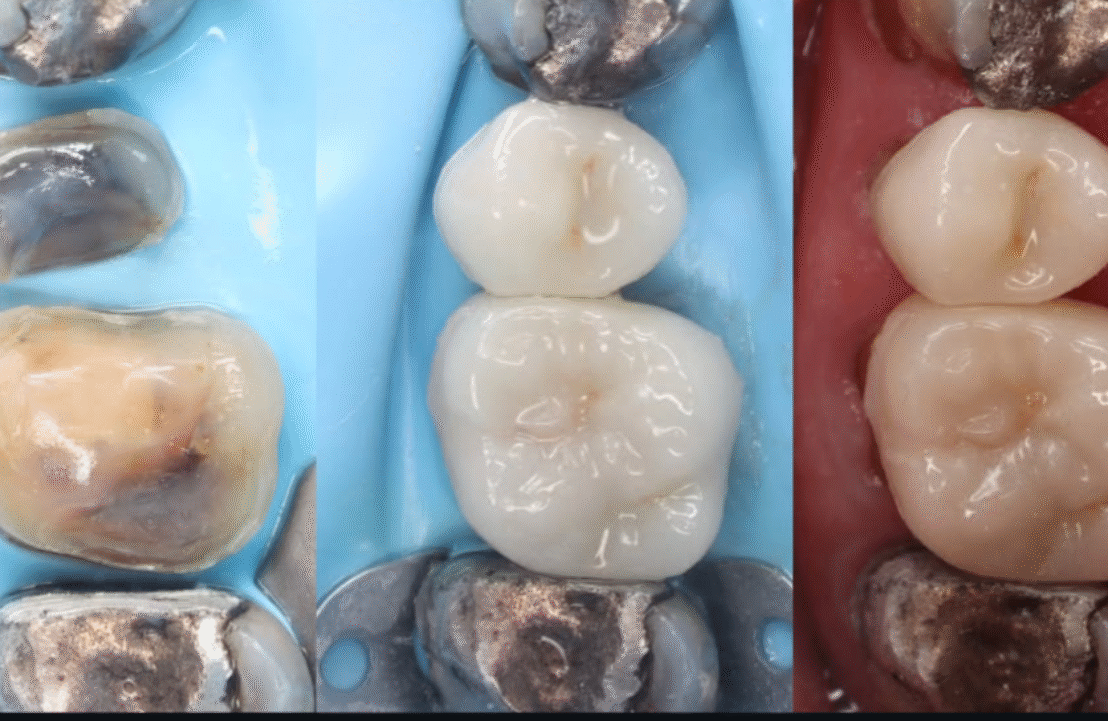 double onlay case