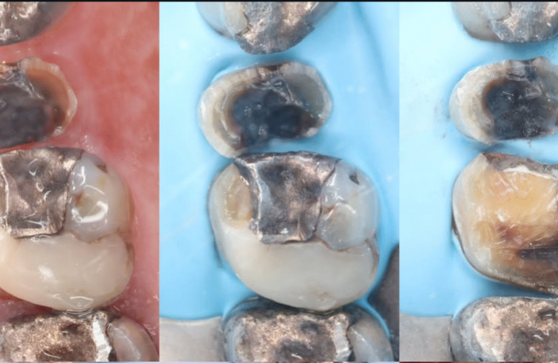 double onlay case