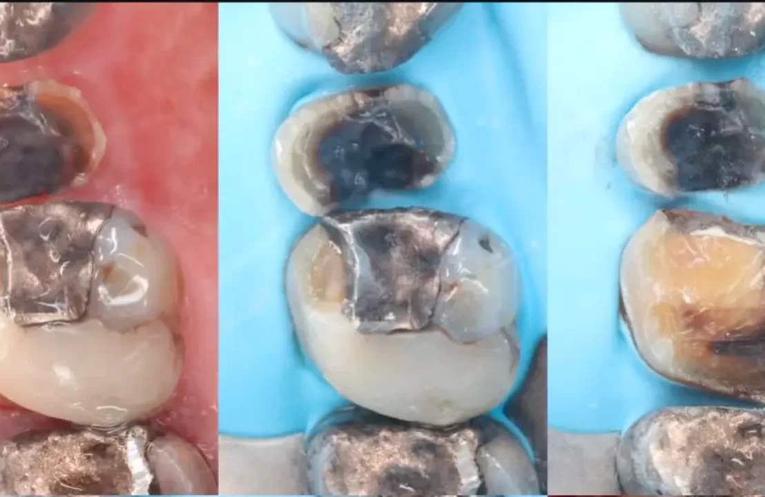 double onlay case