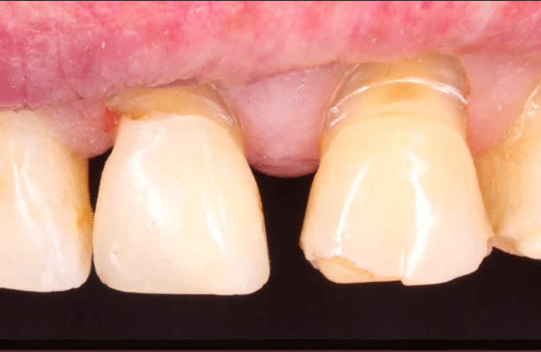 composite build up