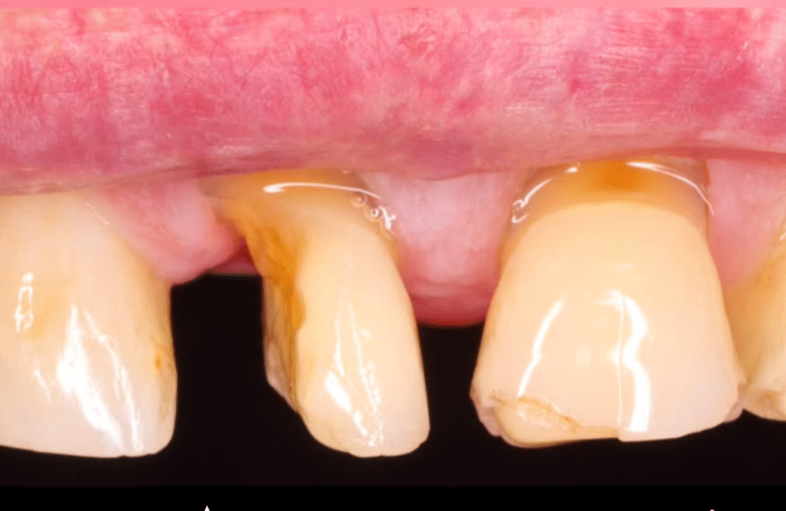 composite build up