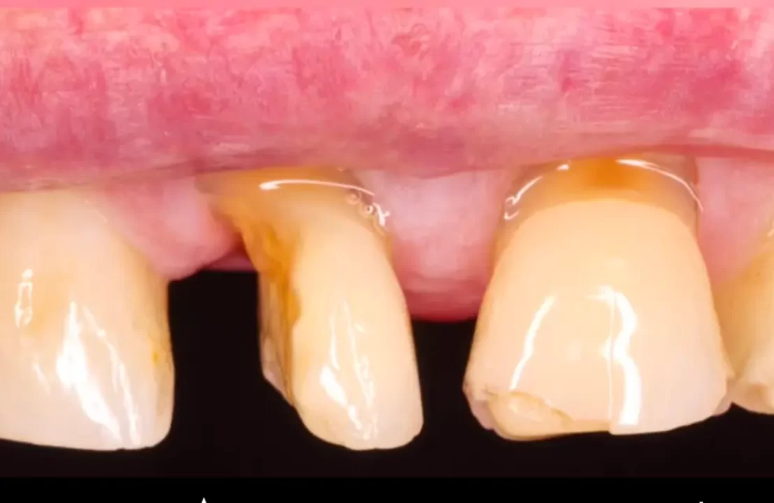 composite build up