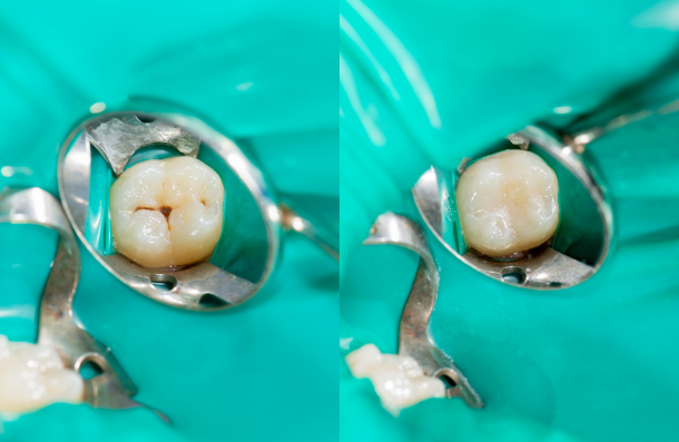 Dental Filling in Plymouth