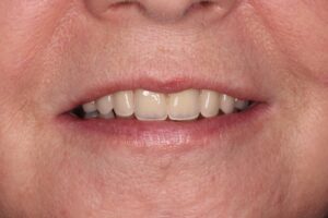Patient wearing a chrome denture