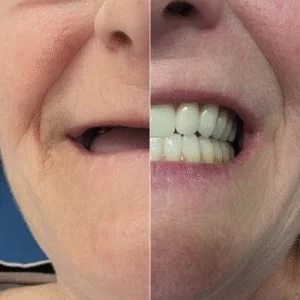 before and after implants