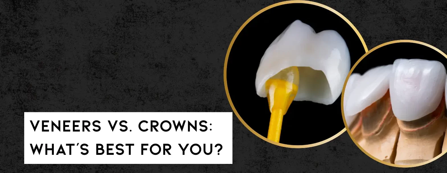 Veneer crown banner