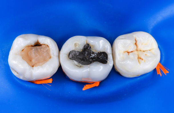 Amalgam filling in tooth