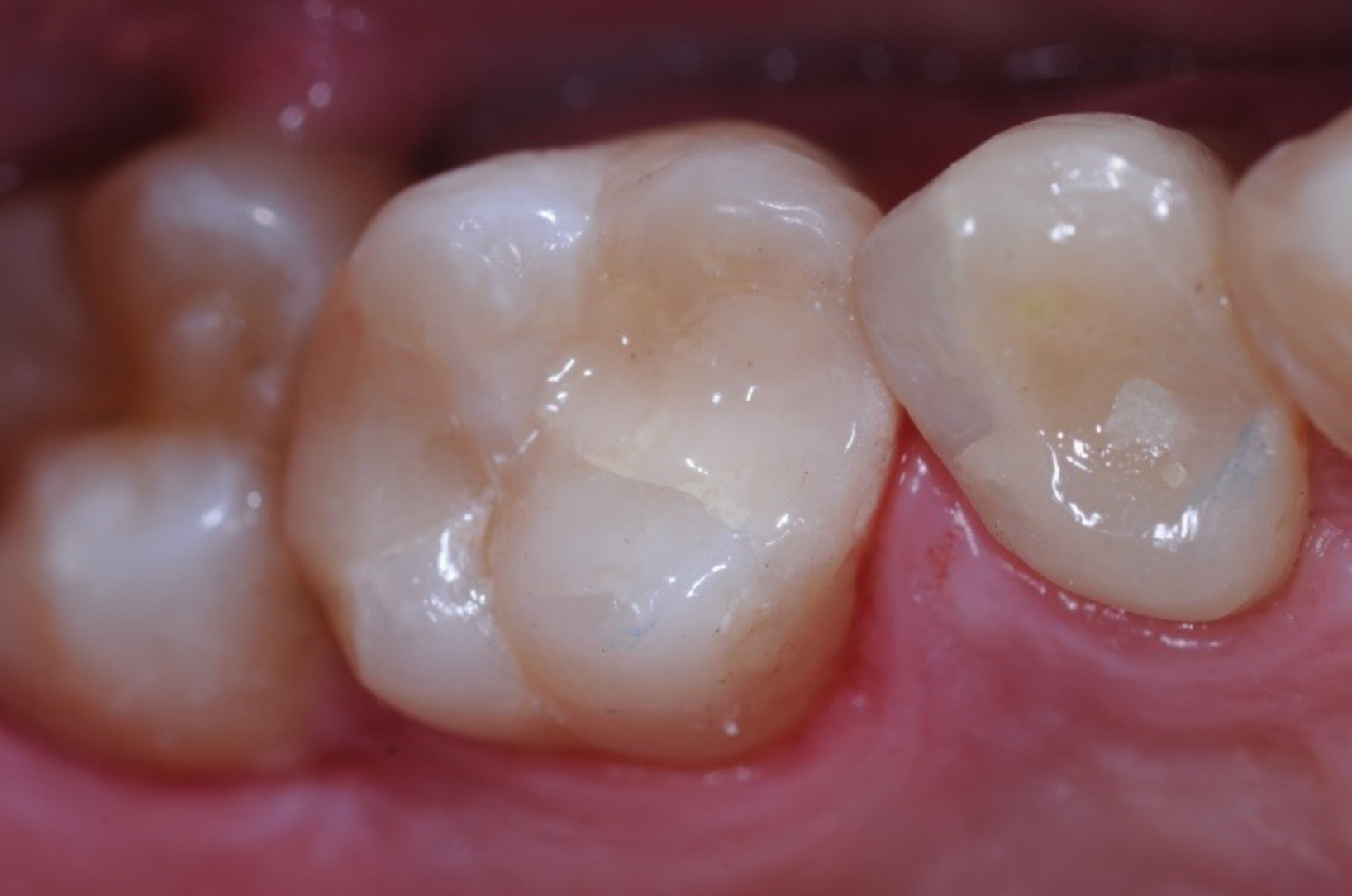 GIC FILLING in tooth