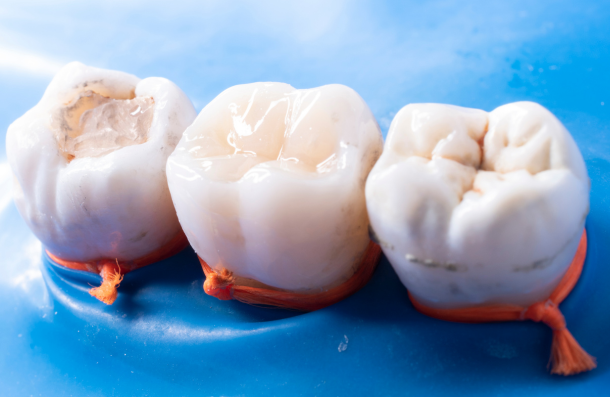 Composite filling in tooth