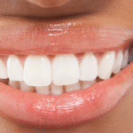 composite bonding featured image