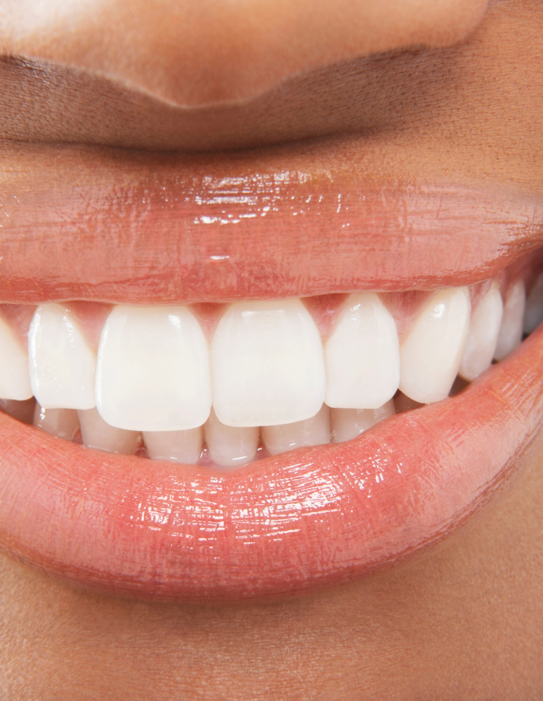 composite bonding featured image