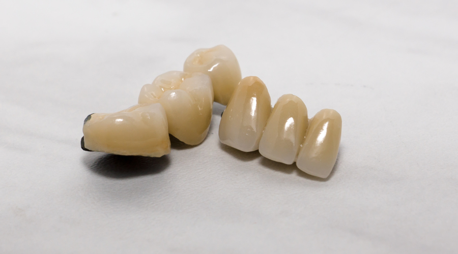 onlay crown bridge treatment