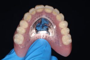 Chrome Denture