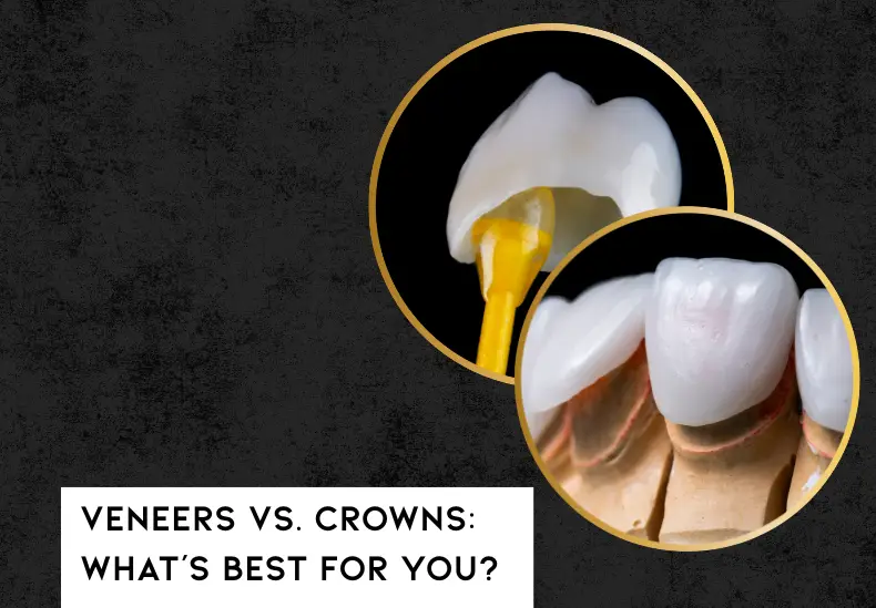 veneer vs crowns featured image
