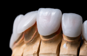 veneers vs crowns