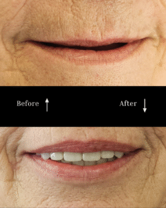 vg before and after implants