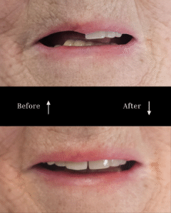 vg before and after implants 2