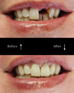 vg before and after implants 3