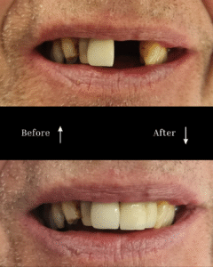 vg before and after implants 5
