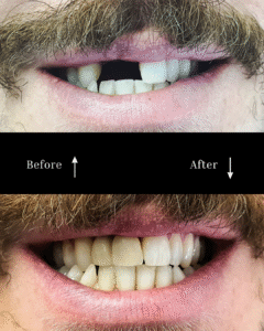 vg before and after implants 6