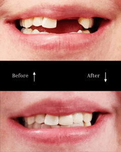 vg before and after implants 7
