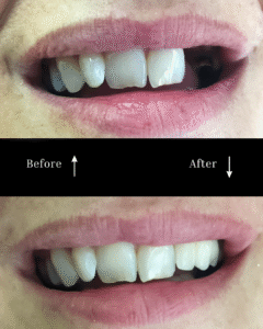 vg before and after implants 8