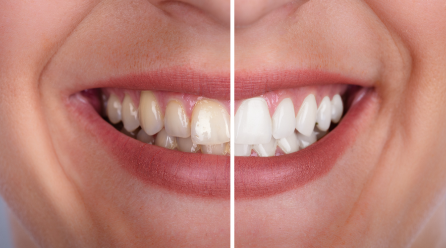 whitening video image