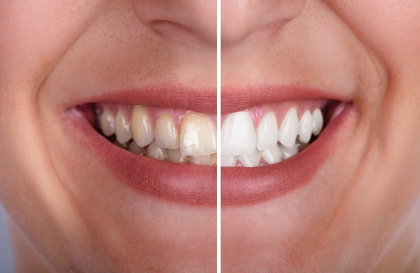 whitening before and after