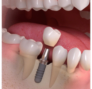 Dental implant in bone