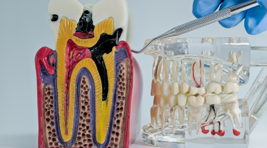 Root canal treatment in Plymouth