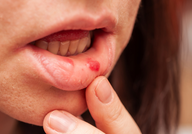 Mouth ulcer
