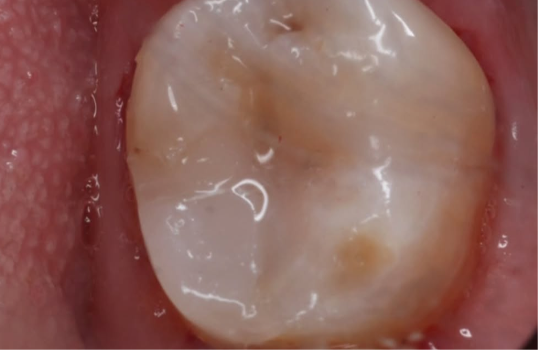 Composite restoration after