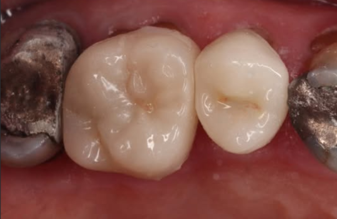 Double Emax onlay after photo